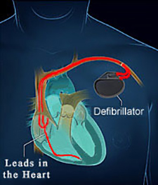 Lake Charles Defibrillator (ICD) Placement